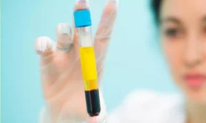 حقن البلازما (PRP)